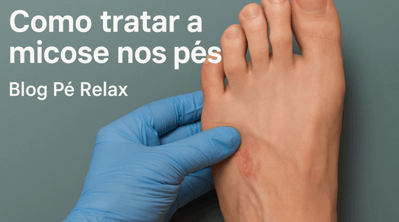 Como tratar a micose nos pés